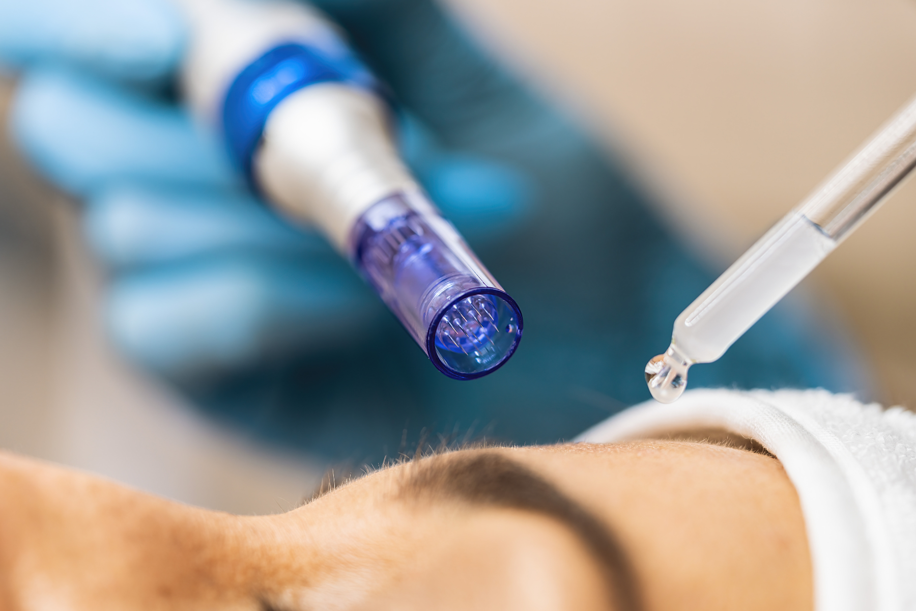 Facial Microneedling: The “Fountain of Youth” My Skin Swears By